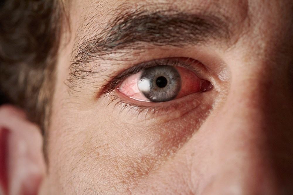 Bệnh đau mắt đỏ tự khỏi sau thời gian bao lâu