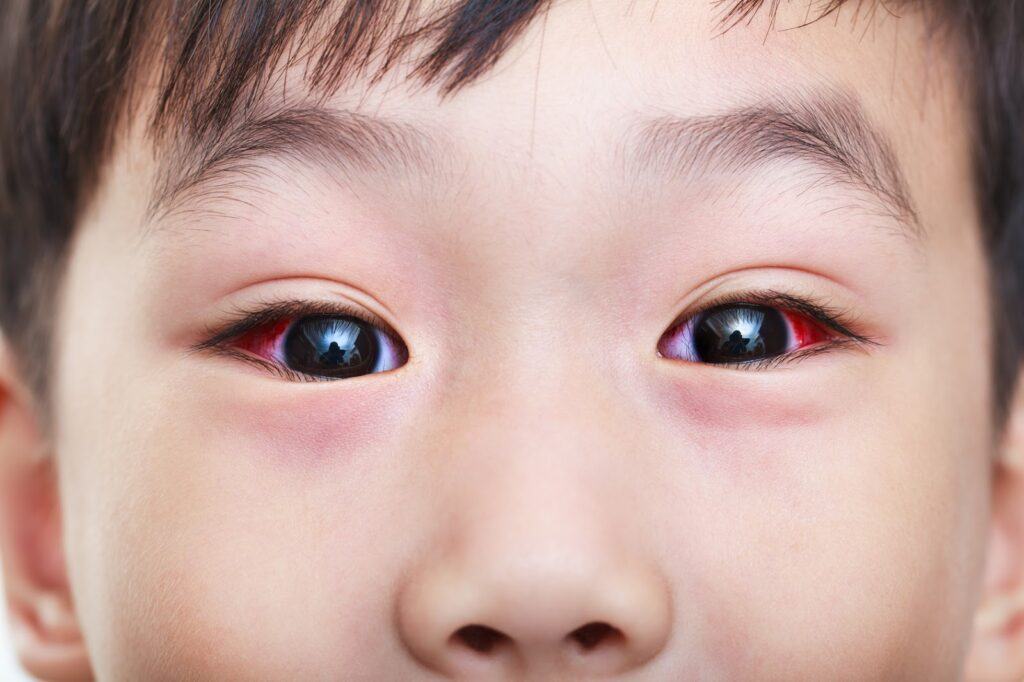 Đau mắt đỏ ủ bệnh bao lâu?