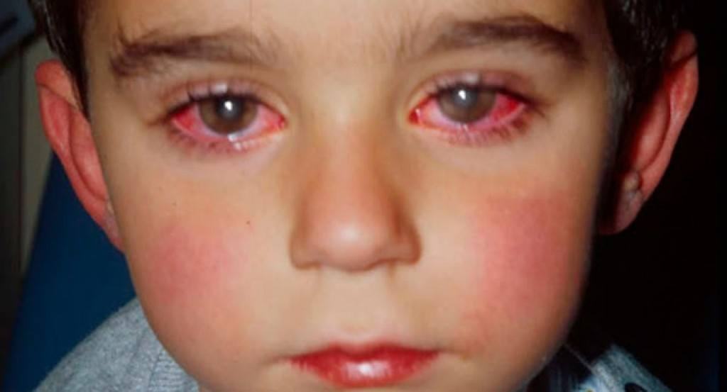 Cha mẹ cần làm khi trẻ bị đau mắt đỏ?