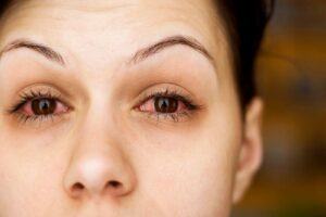 Đau mắt đỏ là gì và những cách phòng ngừa đau mắt đỏ
